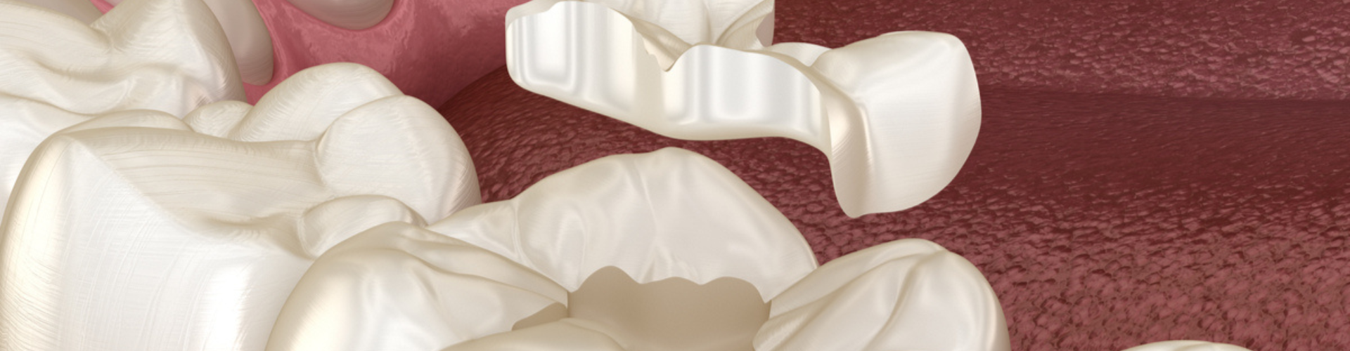 3D image of a tooth getting dental fillings.